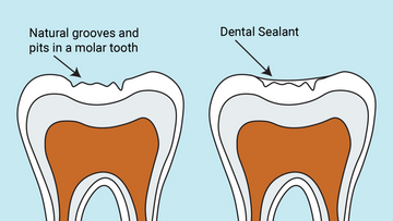 Understanding Dental Sealants: Are They Necessary for Your Child?