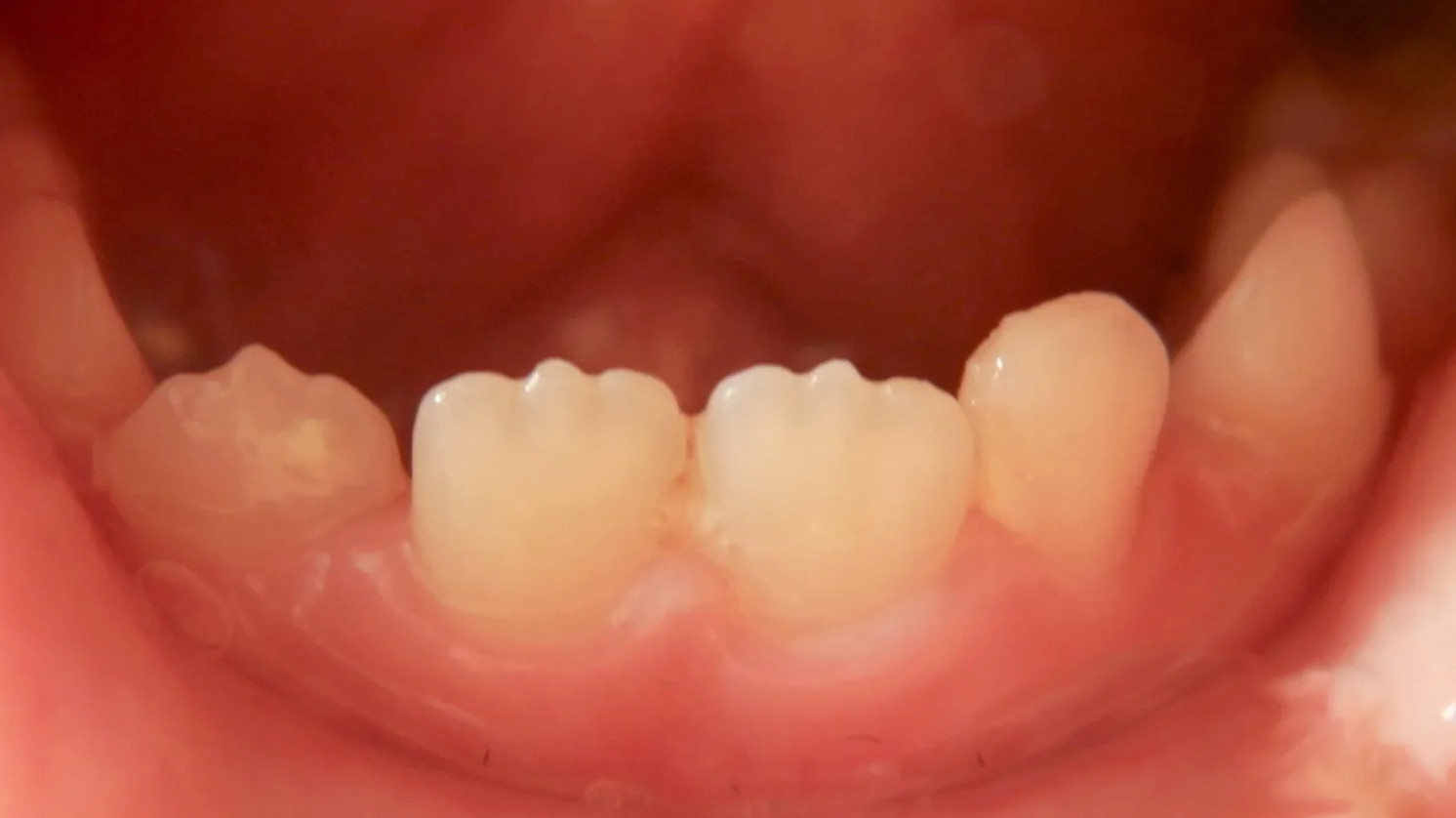 Bumps on the New Adult Teeth