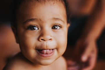 What Is Tongue Tie, And How Is It Treated?