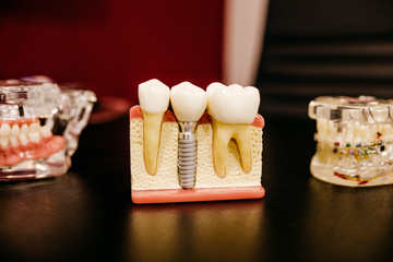 Dental Cavities in Baby and Adult Teeth