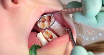 Early stage cavities in kids teeth a complete Guide for Parents and Caregivers